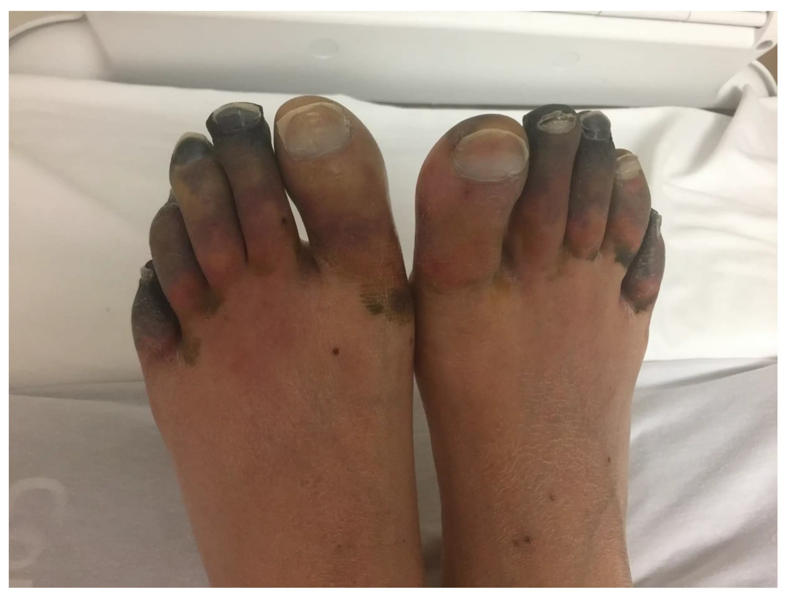 Close-up of untreated diabetic foot wound showing progression to gangrene